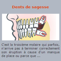 Extraction dents de sagesse