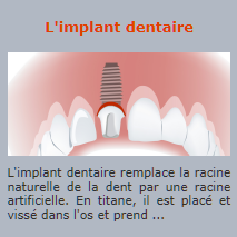 L'implant dentaire