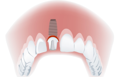 implant-une-dent